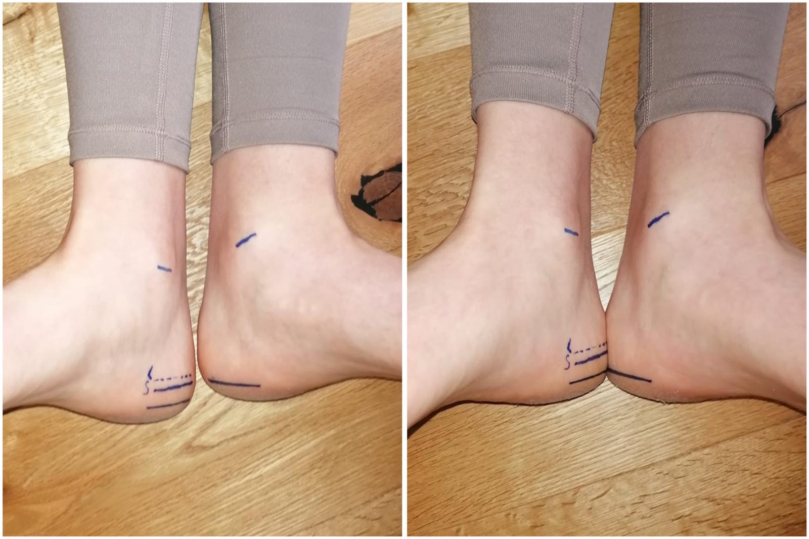 Füße nach Aufrichtung