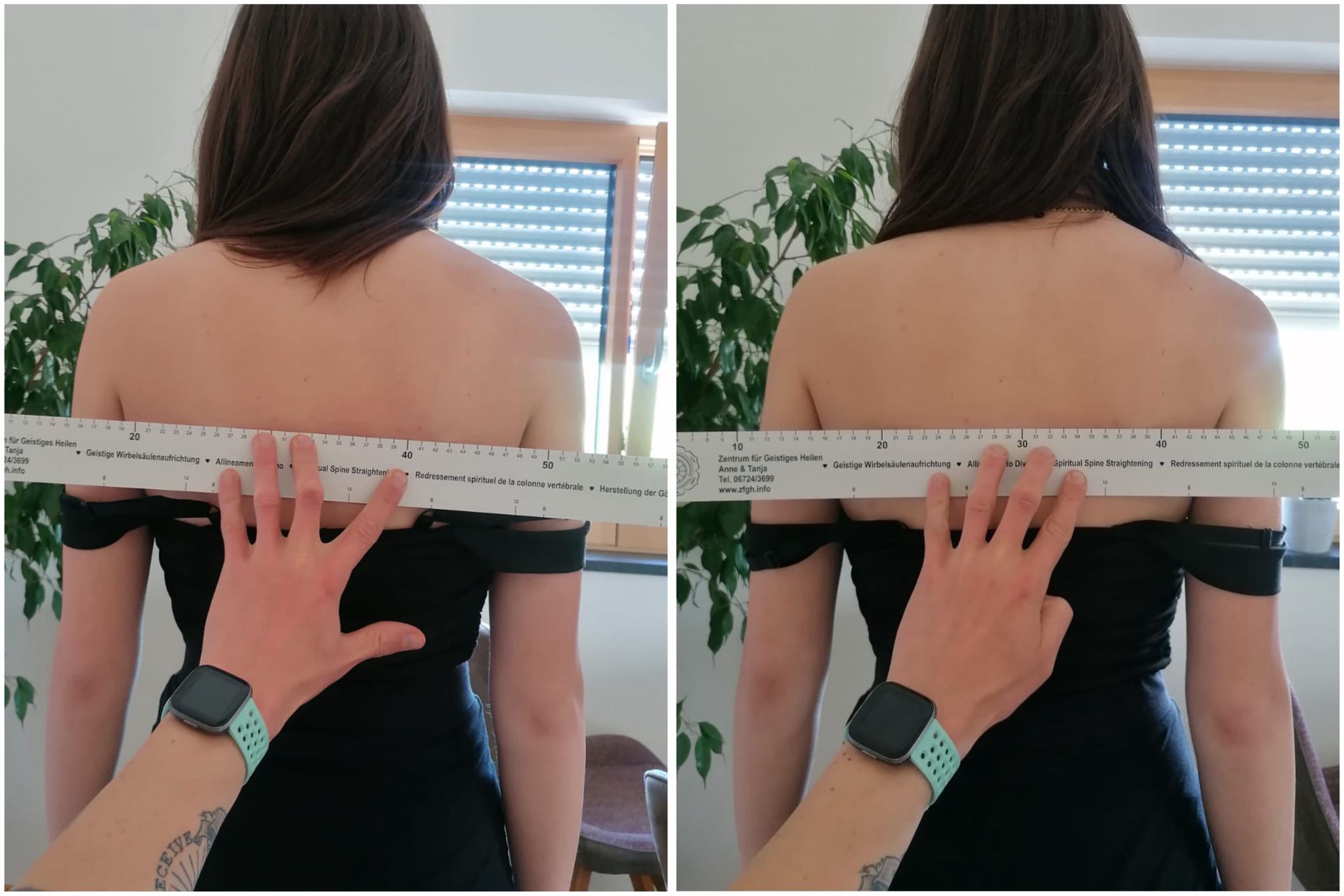 Wirbelsäule nach Aufrichtung